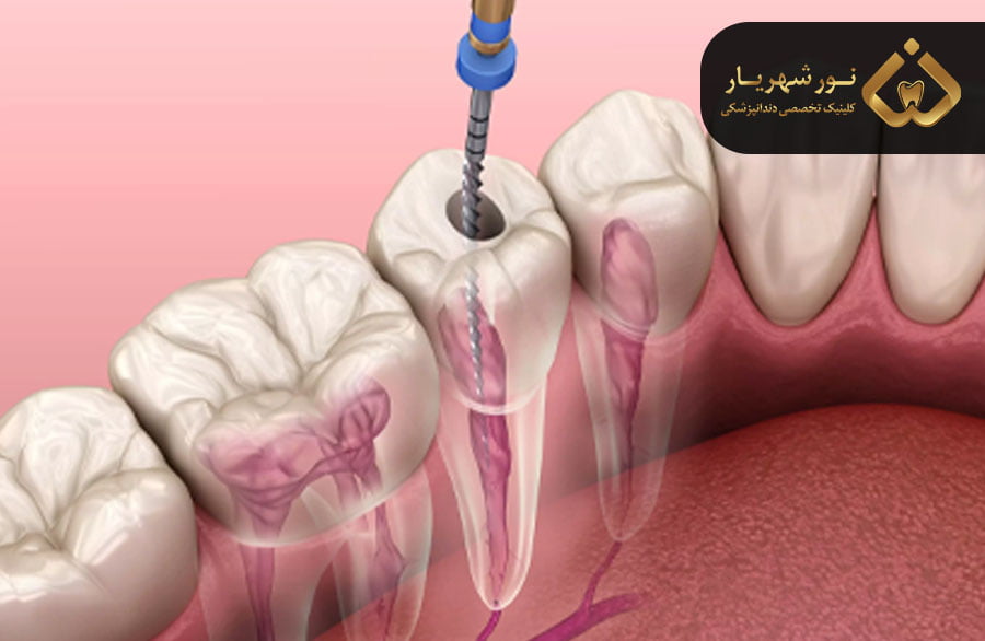 مراقبت های بعد از درمان ریشه
