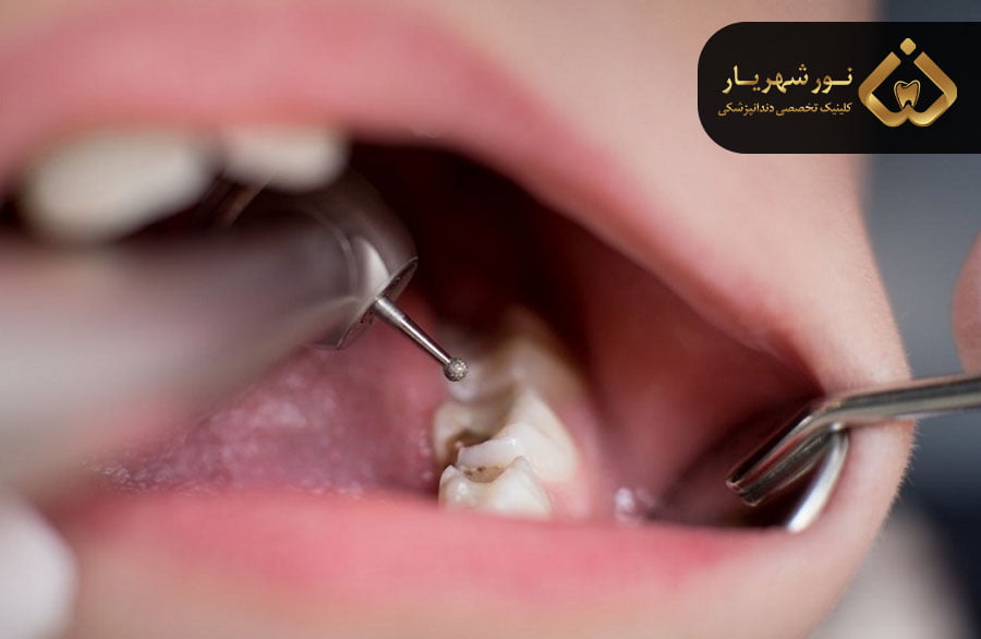 مراقبت های بعد از پالپوتومی و پالپکتومی در کودکان