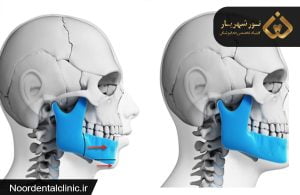 علت بیرون آمدن استخوان فک|متخصصین بیماری های دهان در شهریار