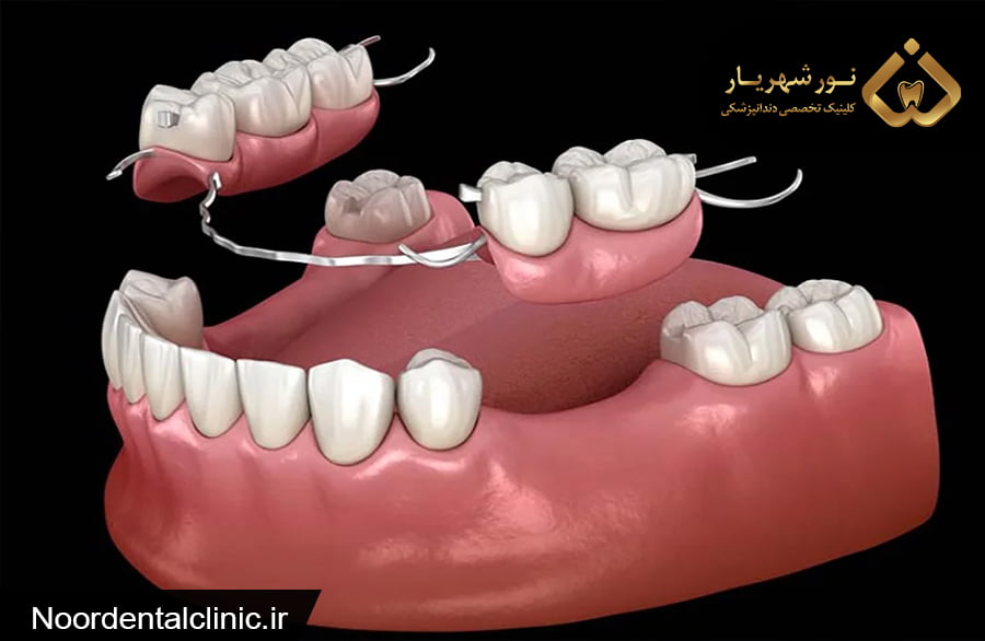 پروتز دندان چیست|متخصص پروتز دندان در شهریار|عکس پروتز دندان