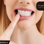 عفونت دندان|متخصص عفونت دندان شهریار|متخصص دهان دندان شهریار