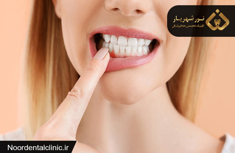 عفونت دندان|متخصص عفونت دندان شهریار|متخصص دهان دندان شهریار