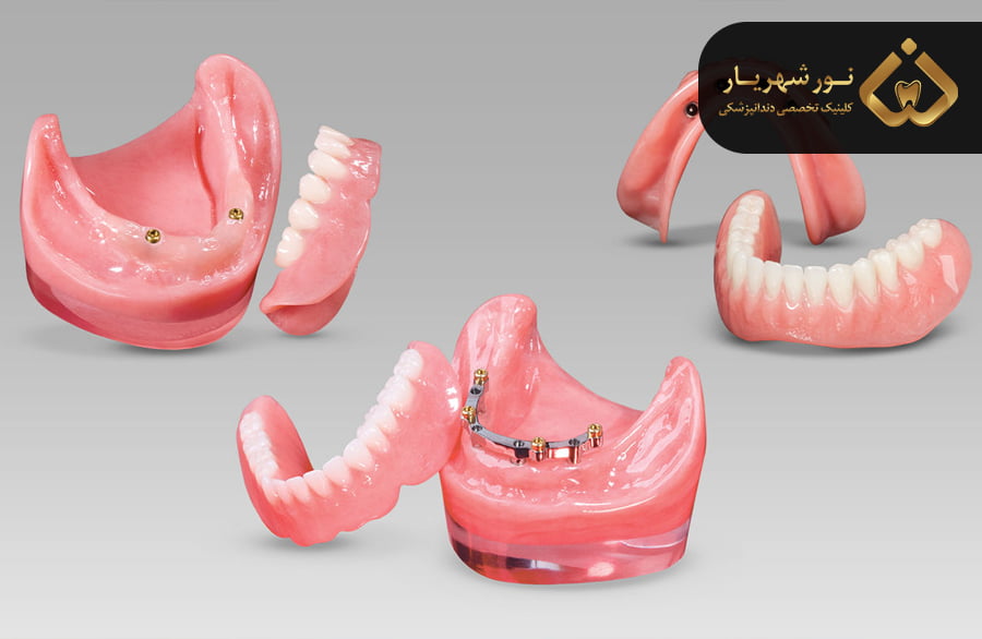 روش های اتجام انواع اوردنچر دندان