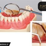 فرق جرمگیری لثه با جرم گیری دندان|متخصص جرمگیری دندان شهریار