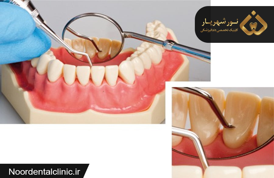 فرق جرمگیری لثه با جرم گیری دندان|متخصص جرمگیری دندان شهریار